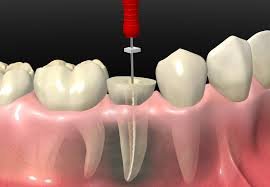 Imagen de Endodoncia (Tratamiento de Conducto)