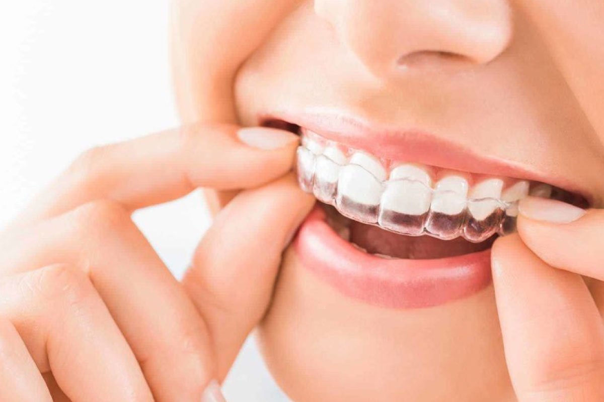 Imagen de Guarda Oclusal (para Bruxismo)